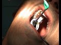 Easyest crown and bridge remover: WAMkey Easyest crown and bridge remover: WAMkey