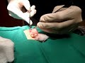 30 yr old sebaceous cyst gets excised