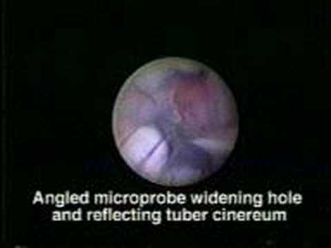 Hydrocephalus   Neurosurgery   ?? ...