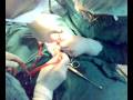 Laminectomy under subarachnoid anesthesia by Dr. Azad J.Ali senior anesthesiologist in Sulaimanyiah teaching hospital in Iraq.mp4