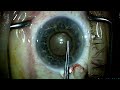 cirugia de catarata pupila pequena grado de dificultad alto