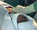 Pacemaker implantation in IGH Pacemaker implantation in IGH