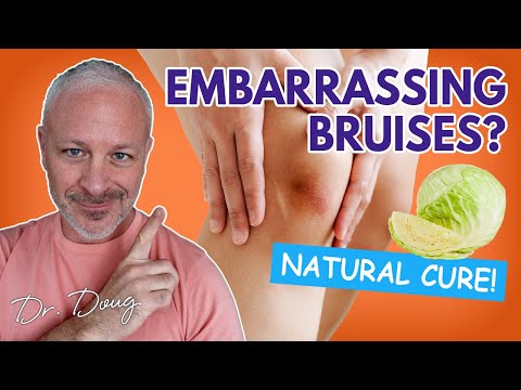 how to cure bruises
