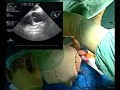 tecniche mini invasive sulla valvola mitralica