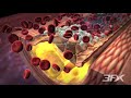 Diabetes-Related Atherosclerosis Diabetes-Related Atherosclerosis