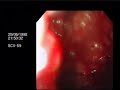 Gastric Varices (GOV 1) Gastric Varices (GOV 1)