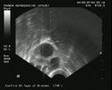 Follicle aspiration