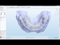 Dental System™ 2010 - Implant Bars and Bridges