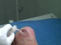 Carboxiterapia