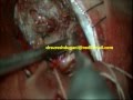 Brain tumor-MID FALCINE LARGE MENINGIOMA-microsurgical removal-dr suresh dugani/HUBLI/INDIA