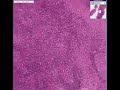 Histopathology Lymph node--Toxoplasmosis