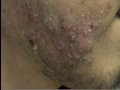 The Acne Practice  (Another Total Inactivation)