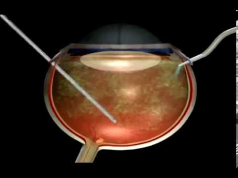 Видео Макулярный разрыв сетчатки и его лечение