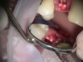 Implant Microsurgery: Untreatable Root Resorption