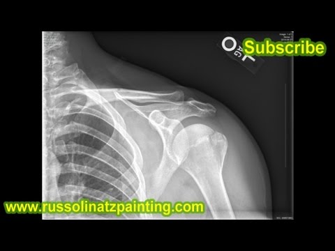how to know fracture in x-ray