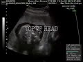 pierce baby ultrasound @ 21 weeks pierce baby ultrasound @ 21 weeks