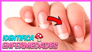 3 - Enfermedades de las uñas. 3 - Enfermedades de las uñas.