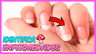 3-Enfermedades de las uñas