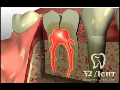 Эндодонтия - распространение первичной инфекции