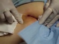 Butt Pus . Doc Lances An Cyst