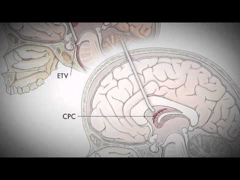 how to drain csf fluid