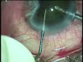 cataract surgery phacoemulsification