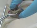 Ball Park Root Canal
