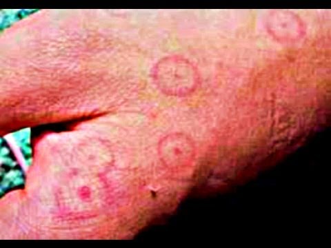 how to treat erythema multiforme