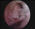 Rotator cuff repair Intraop vs postop ???????????????? Rotator cuff repair Intraop vs postop ????????????????