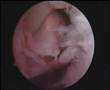 Intraoperatory And Postoperatory Rotator Cuff Correction Comparison