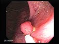 Colon Polypectomy (Colon Polyp Removal) Colon Polypectomy (Colon Polyp Removal)