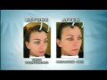ELOS ST vs Botox vs Topical Cream