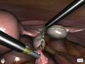 videos de Simulated Salpingectomy
