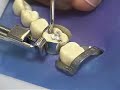 amalgum condensor