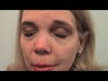 strabismus in adults