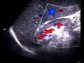 colordoppler renale