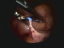 Laparoscopic Appendectomy in a 23 week Primigravida