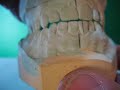Identifying Occlusal Interferences, Nov. 30, 07 Identifying Occlusal Interferences, Nov. 30, 07