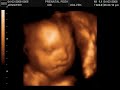 29 week 4D ultrasound