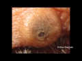 Biggest Black Heads On Eyelids