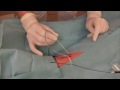 Operatieve correctie hallux valgus