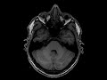 mri scan