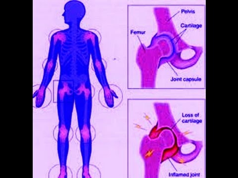 how to treat rheumatism