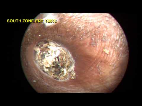 how to dissolve hard ear wax