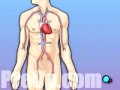 PreOp® Patient Education Coronary Artery Bypass Graft (CABG