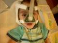 Nemaline Myopathy Paul on Bipap Vocalizing