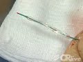 Coronary Angioplasty - procedure to relieve a blocked artery