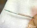 Coronary Angioplasty - procedure to relieve a blocked artery