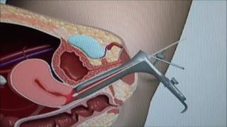 Pap Test Procedure