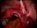 laparoscopic ovarian cystectomy laparoscopic ovarian cystectomy